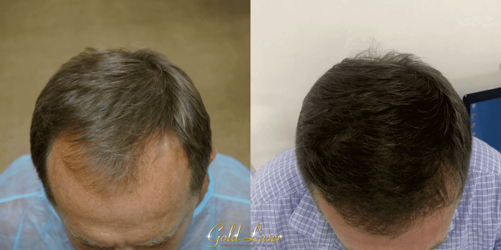 Пересадка волос методами FUE и HFE киев 4