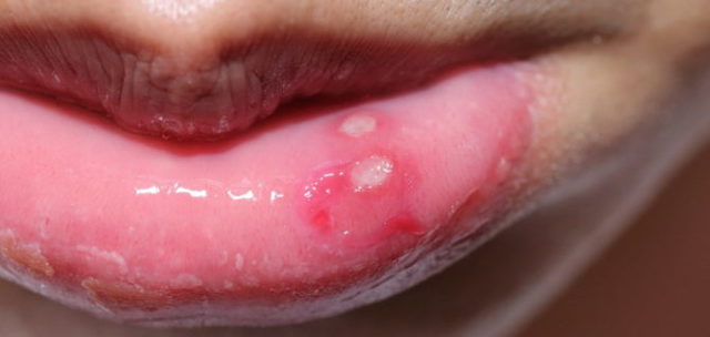 Увеличение губ: противопоказания и побочные эффекты