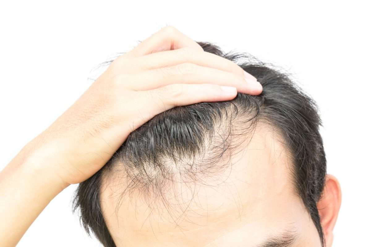 Что такое диффузное выпадение волос: лечение у женщин и мужчин | блог Gold  Laser