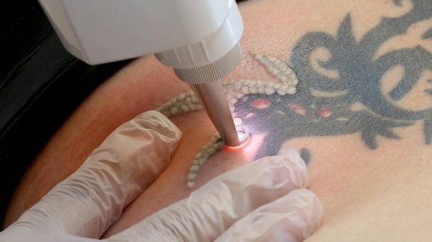 Удаление татуировок лазером