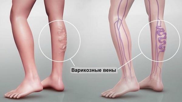 Операция по удалению вен на ногах последствия и осложнения - отзывы пациентов и врачей