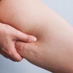 как избавиться от целлюлита