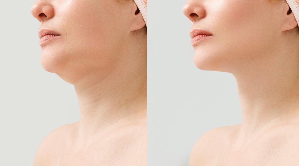 Брыли на лице - как избавиться у косметолога или с помощью операции