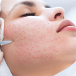 Мезотерапия или биоревитализация: что лучше и в чем разница