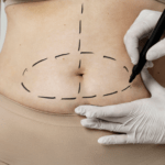 Неудачная липосакция: какие могут быть осложнения после процедуры